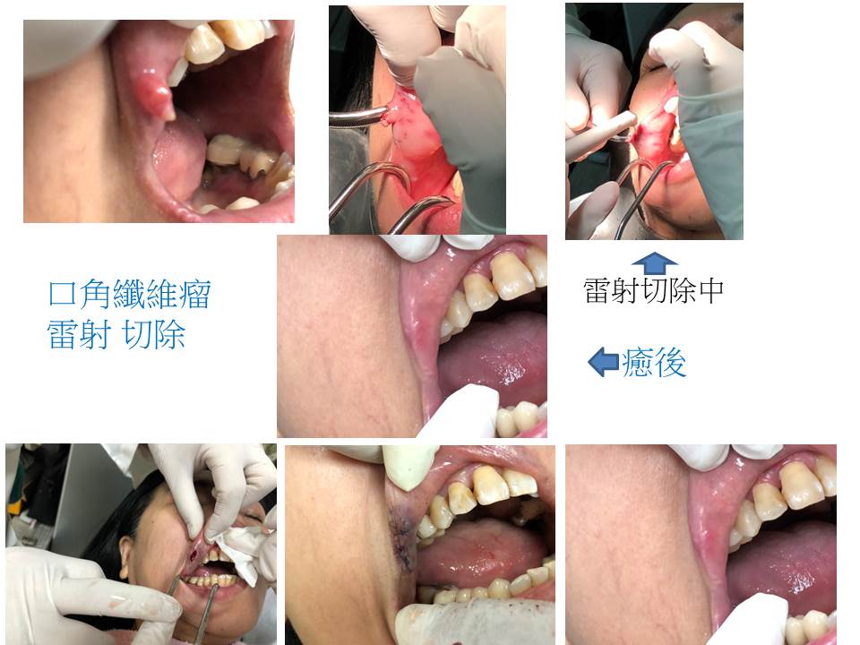 口角纖維瘤雷射切除